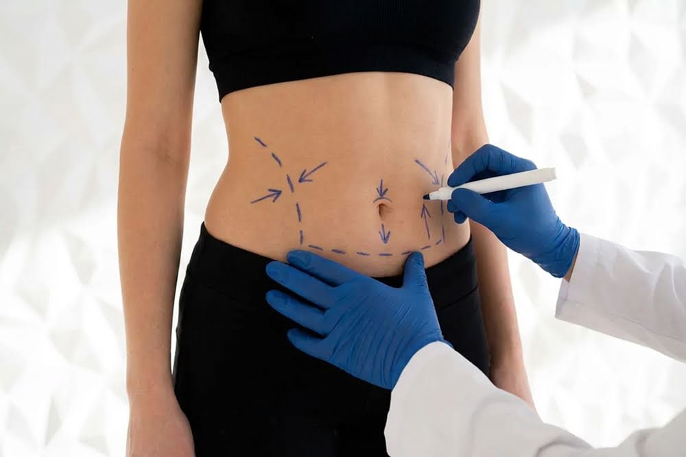 Endolift Silhouette – Body Lift & Definition 1