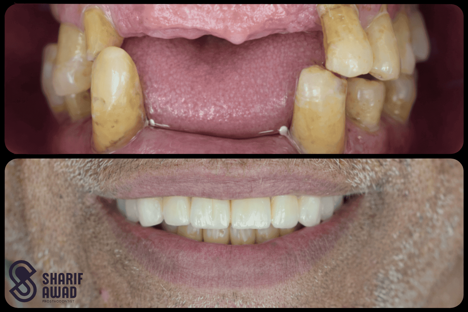 All-on-X Full Mouth Dental Implant Package 2