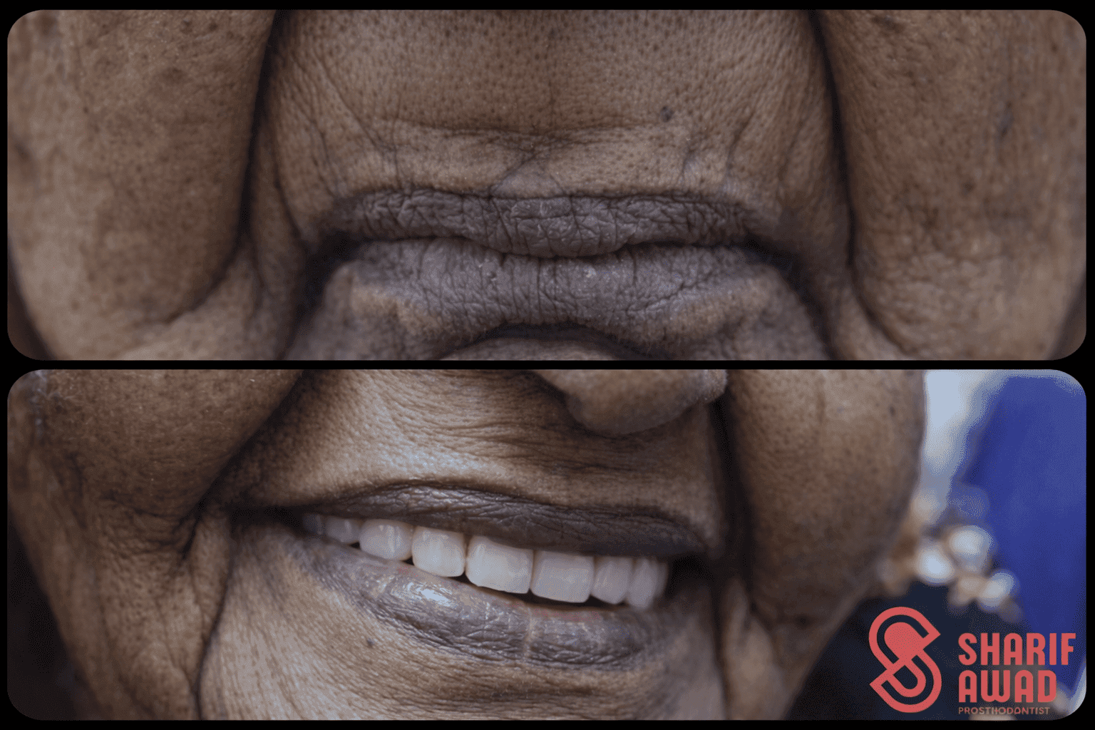 All-on-X Full Mouth Dental Implant Package 3