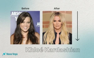 Khloe Kardashian nose job