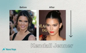 Kendal Jenner nose job