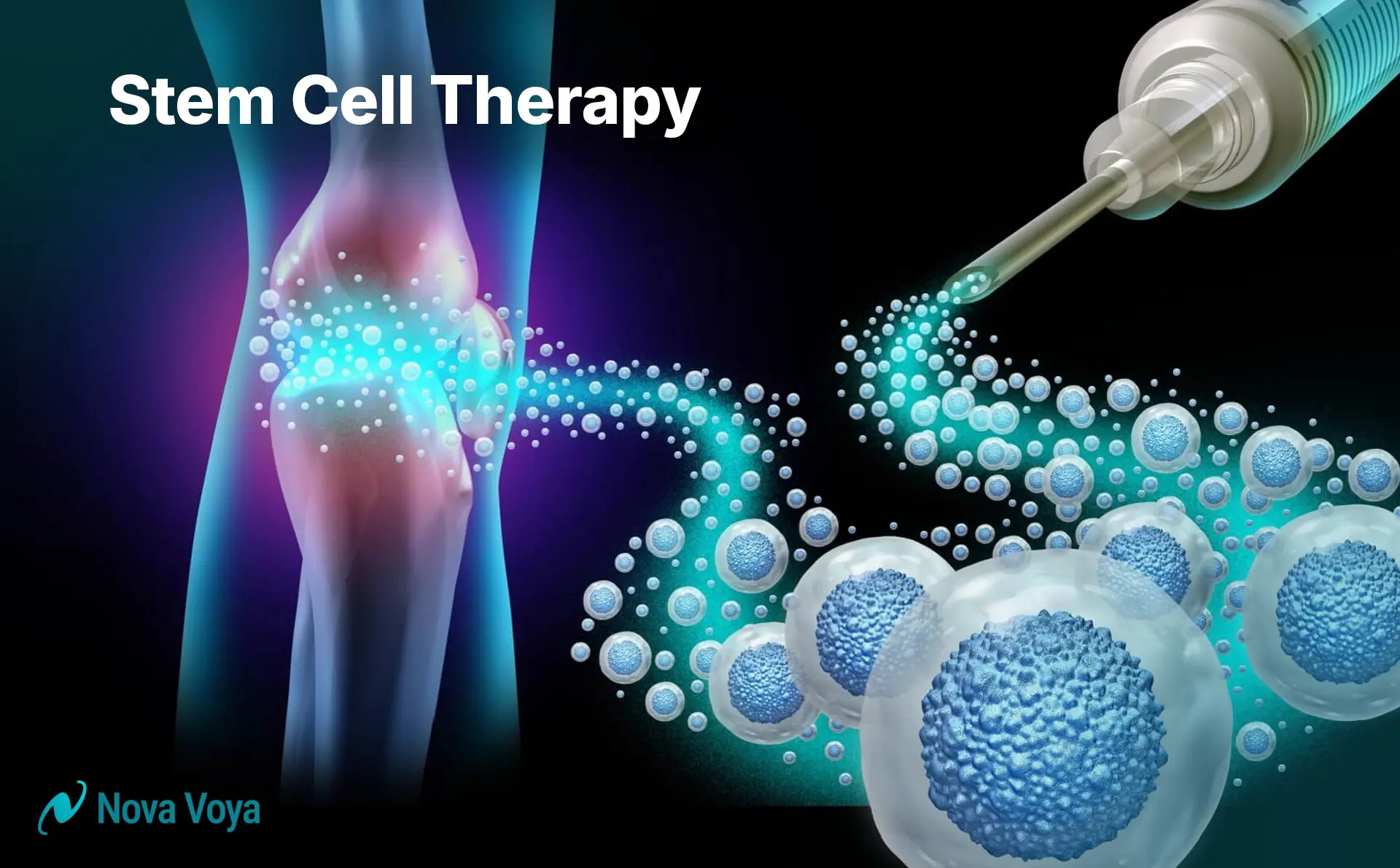 Illustration of a minimally invasive stem cell injection into the knee joint for osteoarthritis treatment, often guided by imaging.