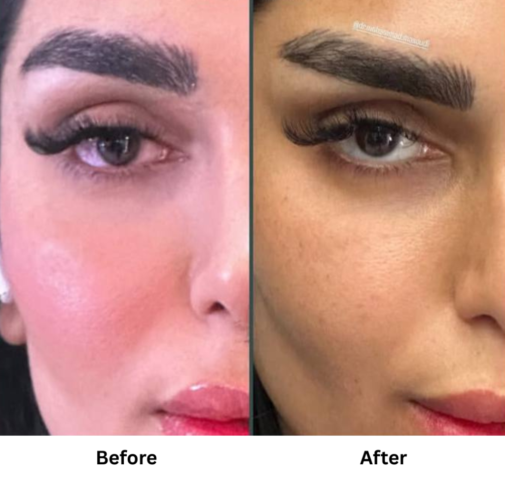 result of cat eyes with botox
