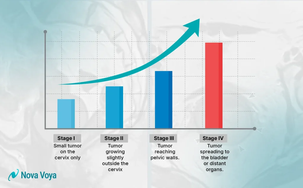Illustration showing the four stages of cervical cancer progression from the cervix to other organs.