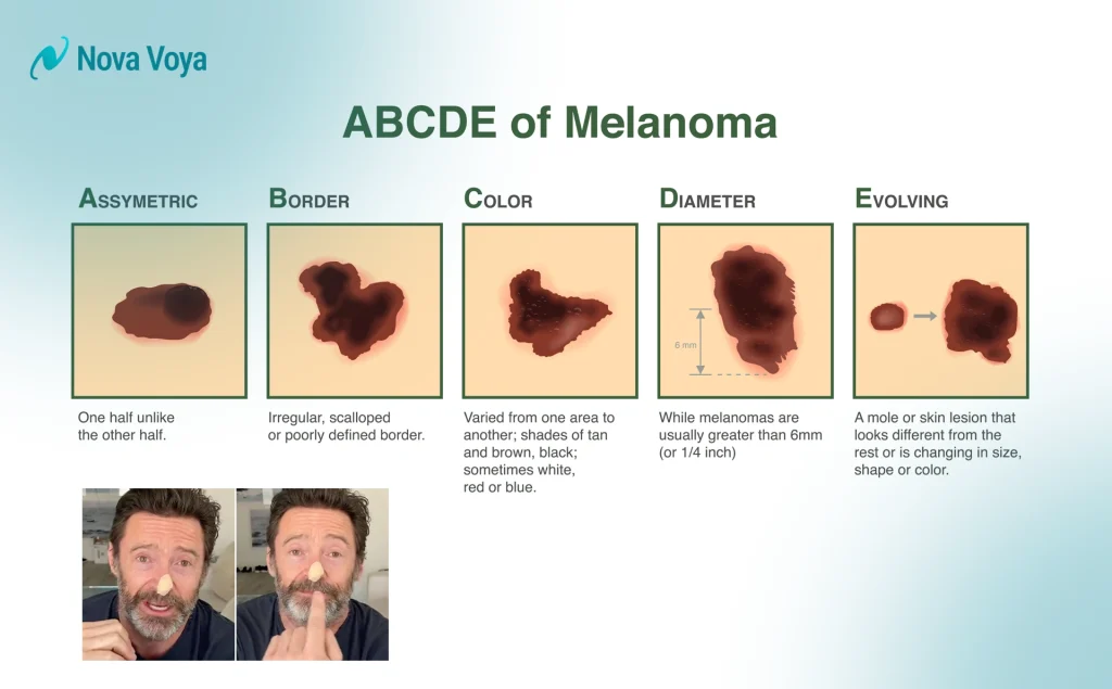 The ABCDE guide to identifying skin cancer: Asymmetry, Border, Color, Diameter, and Evolving, featuring Hugh Jackman.