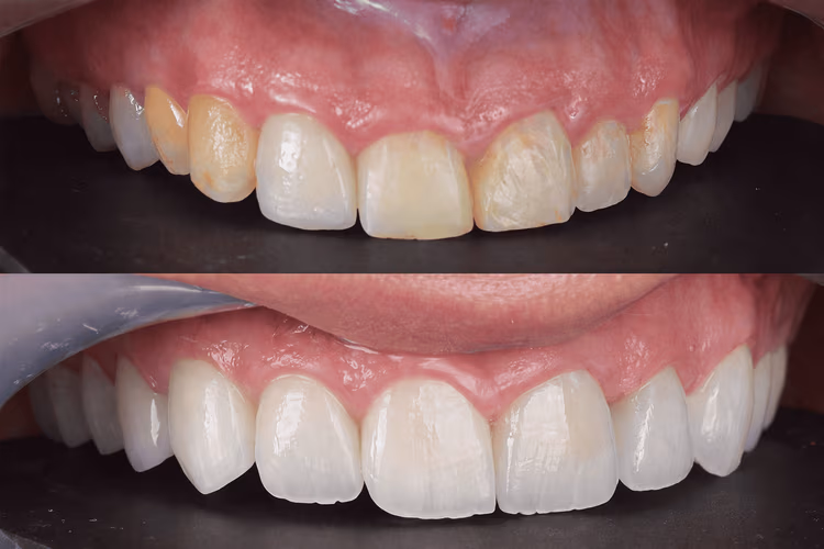 Dr. Sharif awad - veneer results