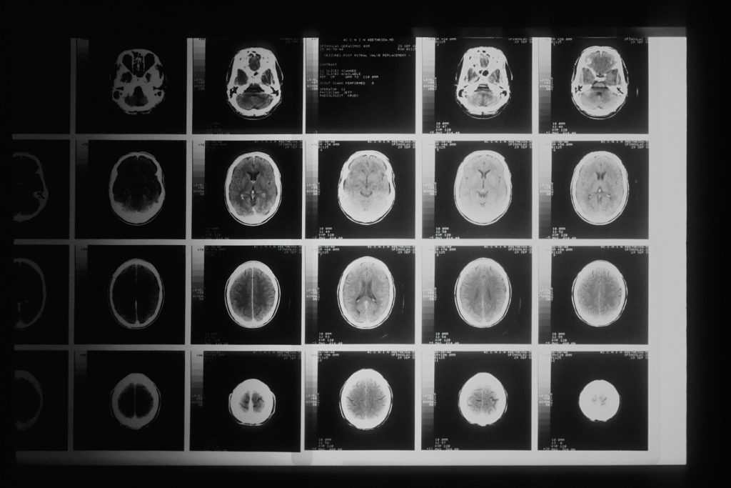 Neurosurgery in Dubai: Brain Tumors and Cerebral Aneurysms