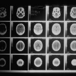 Neurosurgery in Dubai: Brain Tumors and Cerebral Aneurysms