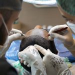 Natural-Looking Hair Transplant in Dubai for Executives