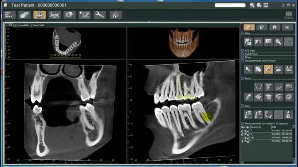 Diagnostics and 3D Imaging Phase for Implant Procedure in Dental Clinics
https://northbranddental.com/understanding-the-advantages-of-3d-dental-imaging/