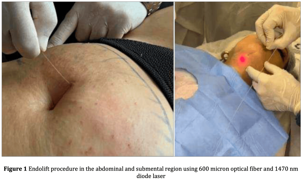 How Endolift Actually Works