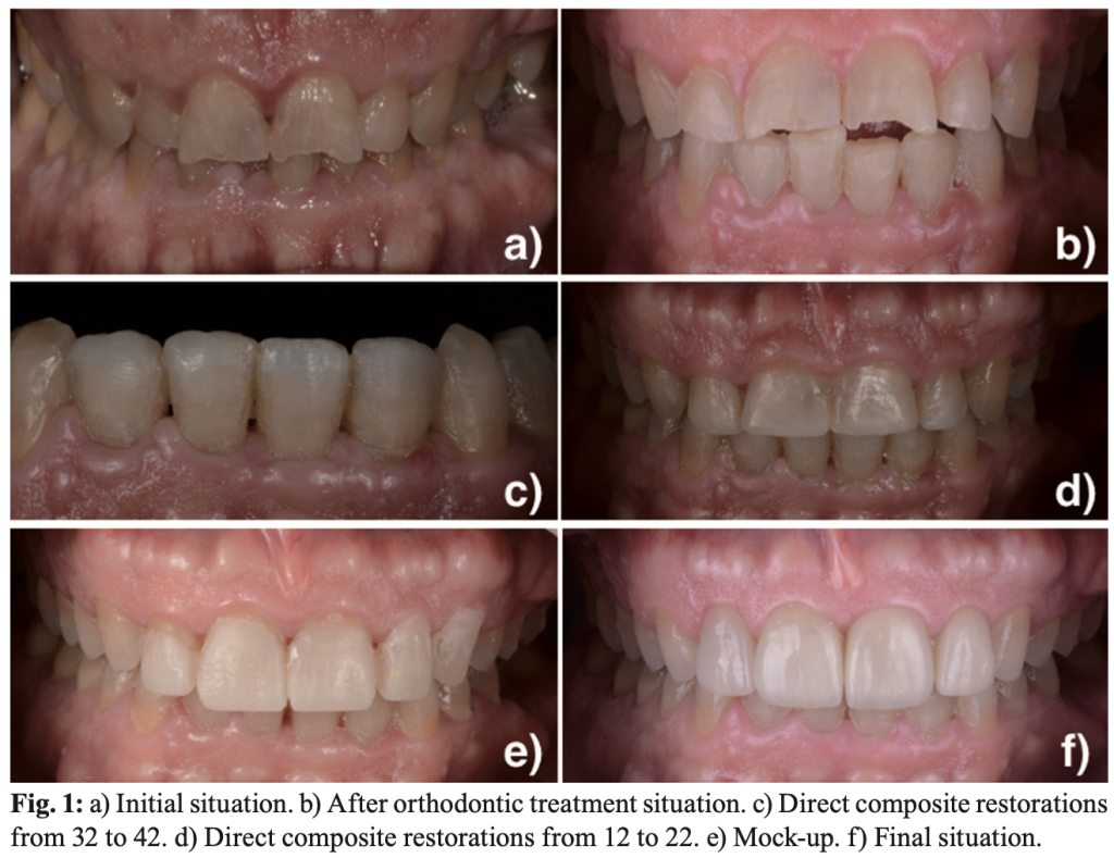 When Orthodontics Must Come First