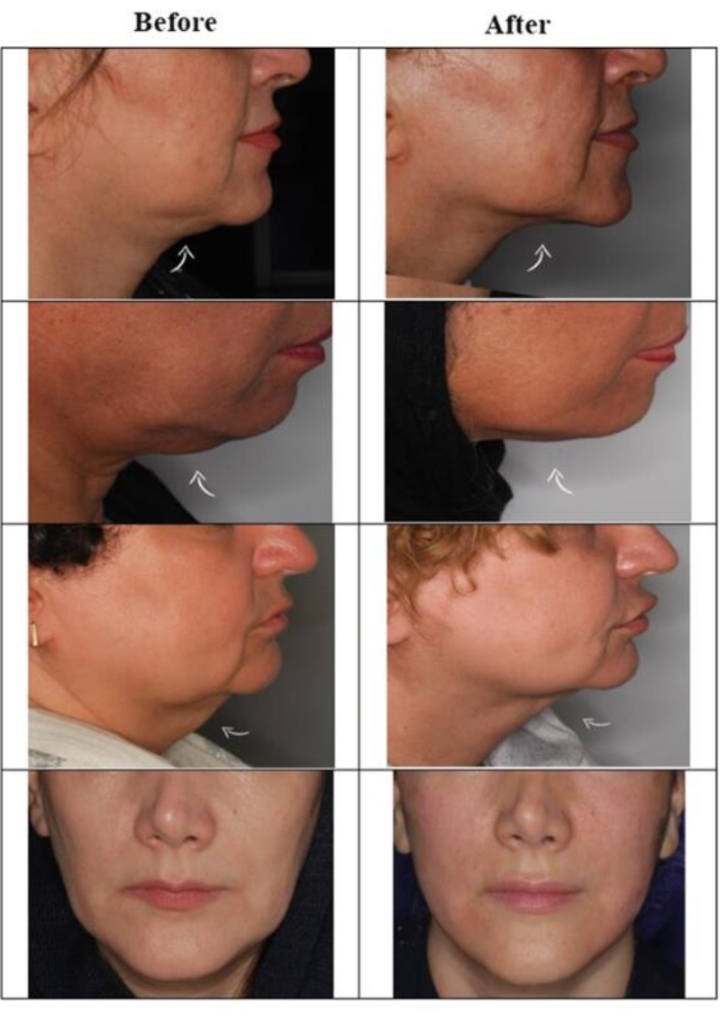 Which Facial Areas Respond Best to Endolift?