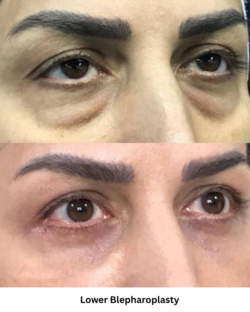 Lower Blepharoplasty Result