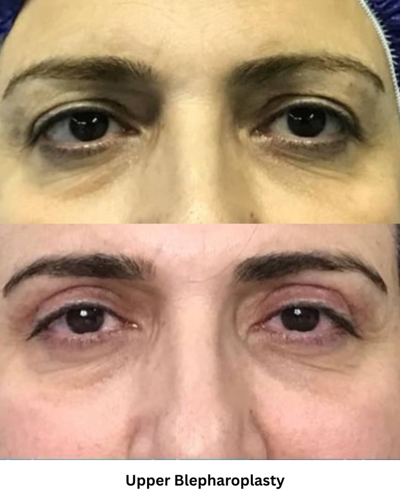 Upper blepharoplasty result