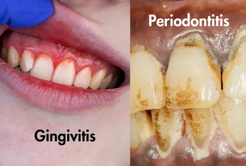 Gum-Disease-Gingivitis-and-Periodontitis