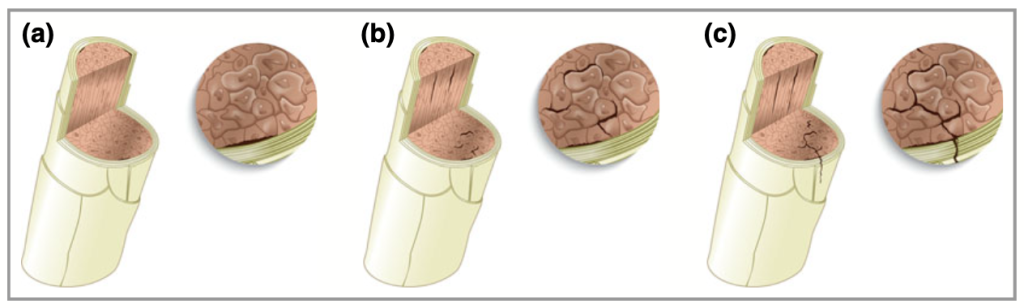 Schematic representation of the hair-breakage mechanism. (a) Failure of the cuticle–cortex interface; observe the crack separating cuticle
from cortex. (b) Formation of intercellular cracks. (c) Propagation of cracks further into the cortex and towards the surface.