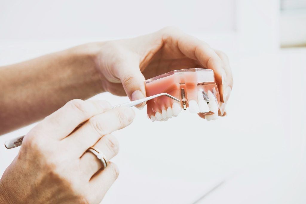 All-on-4 vs All-on-6 vs All-on-8: Which Full Mouth Implant Option Actually Lasts in Dubai?