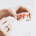 All-on-4 vs All-on-6 vs All-on-8: Which Full Mouth Implant Option Actually Lasts in Dubai?