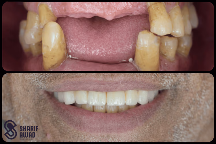 All-on-X Full Mouth Implant
