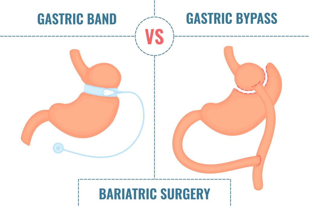Metabolic / Bariatric Surgery: Weight-loss surgeries that physically alter the stomach or intestines. They don't just reduce how much you can eat; they actually change your gut hormones to fix your metabolism.
