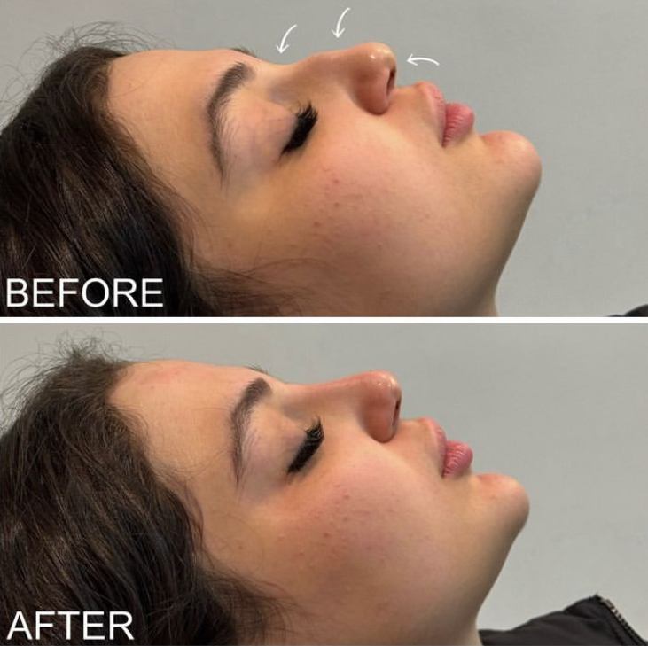 result of Non-Surgical Rhinoplasty