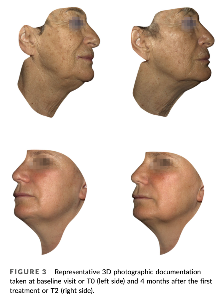Representative 3D photographic documentation
taken at baseline visit or T0 (left side) and 4 months after the first
treatment or T2 (right side).