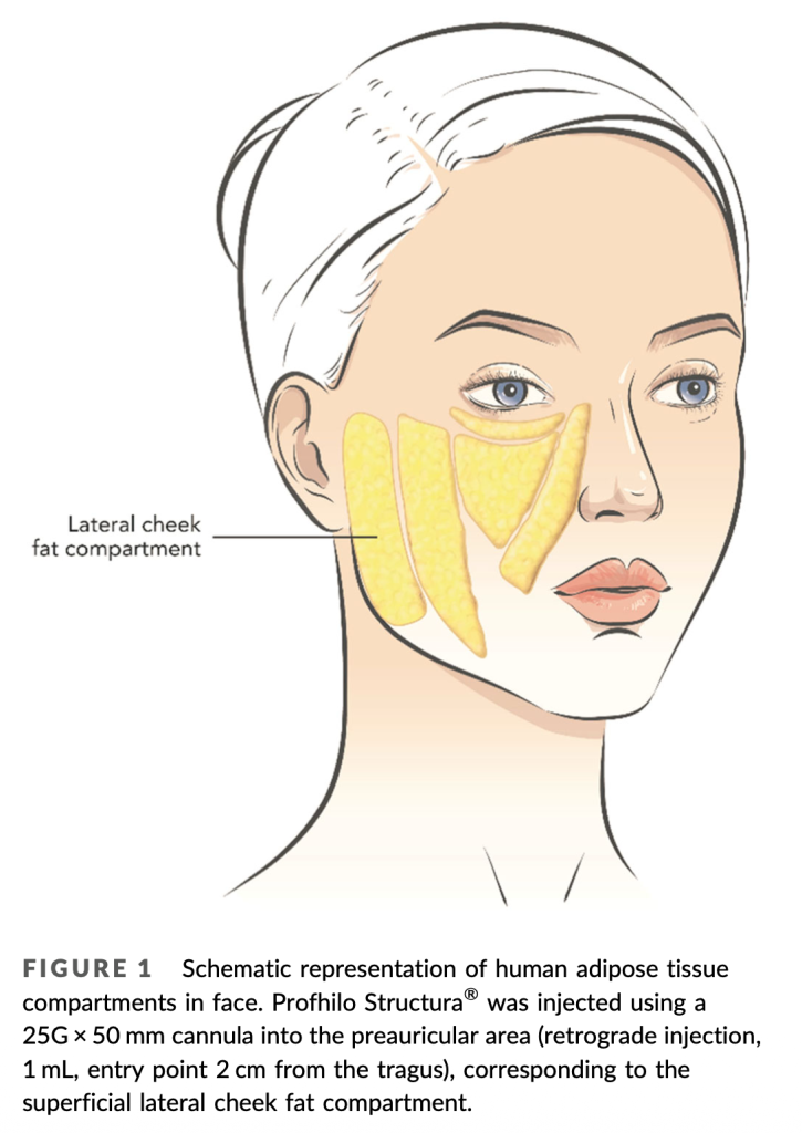 Schematic representation of human adipose tissue
compartments in face. Profhilo Structura® was injected using a
25G × 50 mm cannula into the preauricular area (retrograde injection,
1 mL, entry point 2 cm from the tragus), corresponding to the
superficial lateral cheek fat compartment.