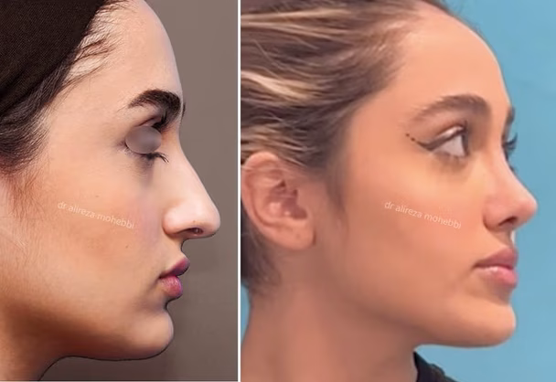 results of Surgical rhinoplasty