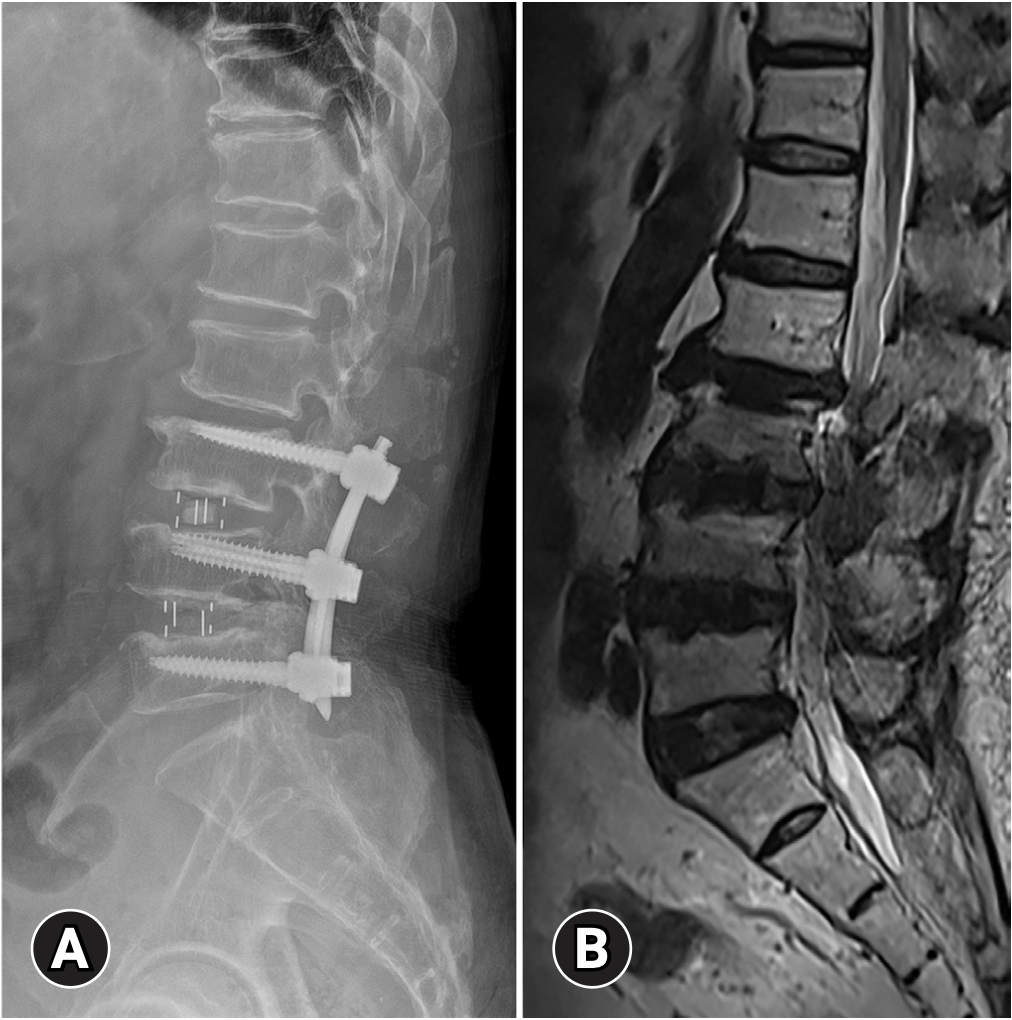 X-ray and MRI showing adjacent segment degeneration after lumbar spinal fusion surgery in a failed back surgery syndrome patient