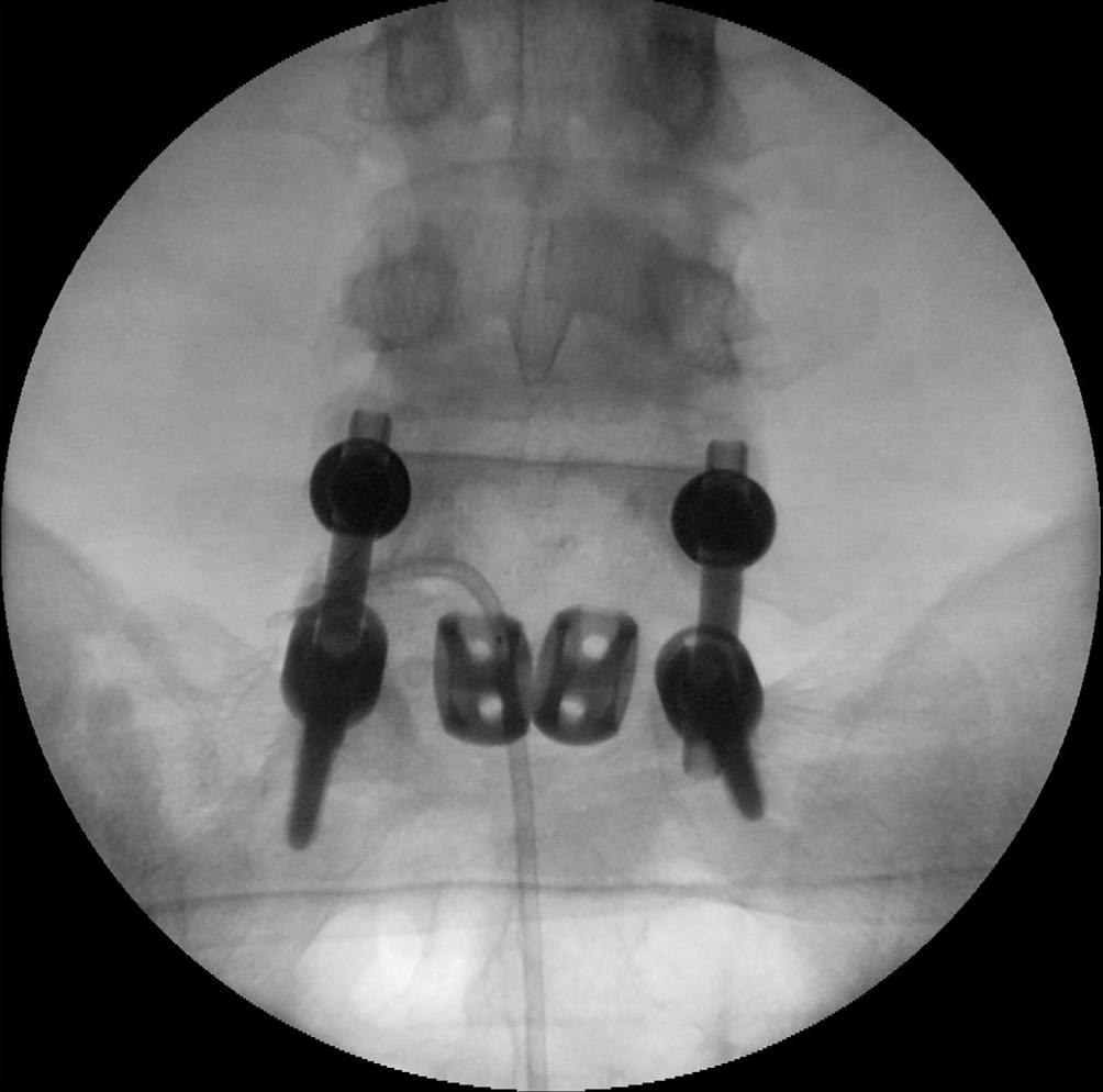 Fluoroscopic image of epiduroscopic adhesiolysis procedure for treating epidural fibrosis in failed back surgery syndrome
