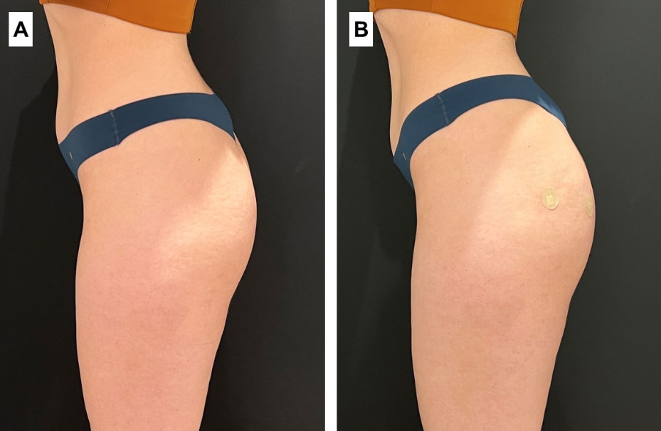 before and after of hip filler