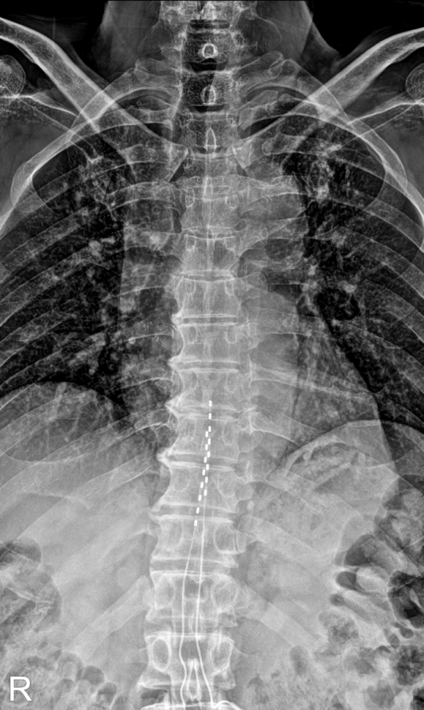 X-ray image of spinal cord stimulator implantation with electrodes placed along the thoracic spine for FBSS pain relief