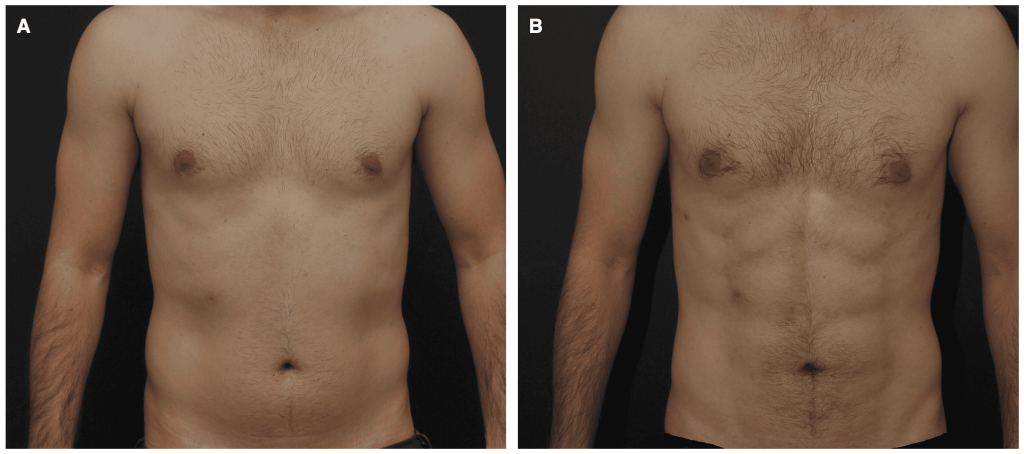 (A) Preoperative view of a 25-year-old male. (B) Two-year postoperative view following RDL of the abdomen and flanks.