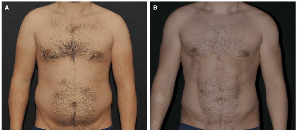 (A) Preoperative view of a 27-year-old male. (B) Six-year postoperative view following HDL of the flanks, chest, abdomen, and arms.
